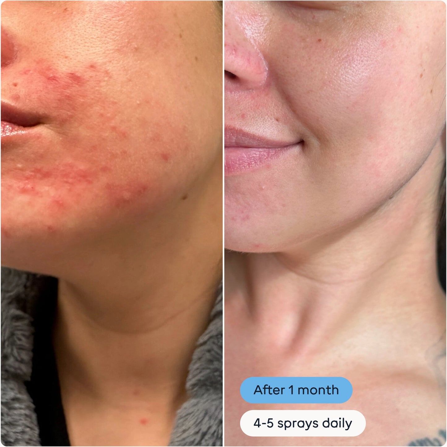 Daily Antimicrobial Skin Spray For Breakouts and Flare-ups