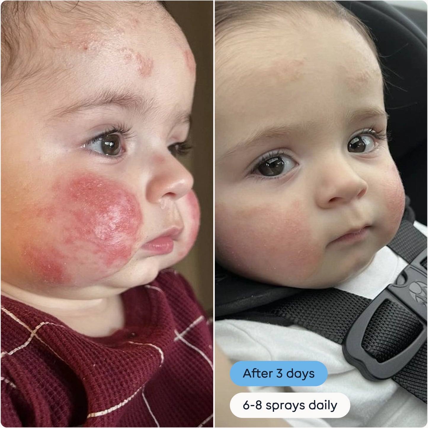 Daily Antimicrobial Skin Spray For Breakouts and Flare-ups