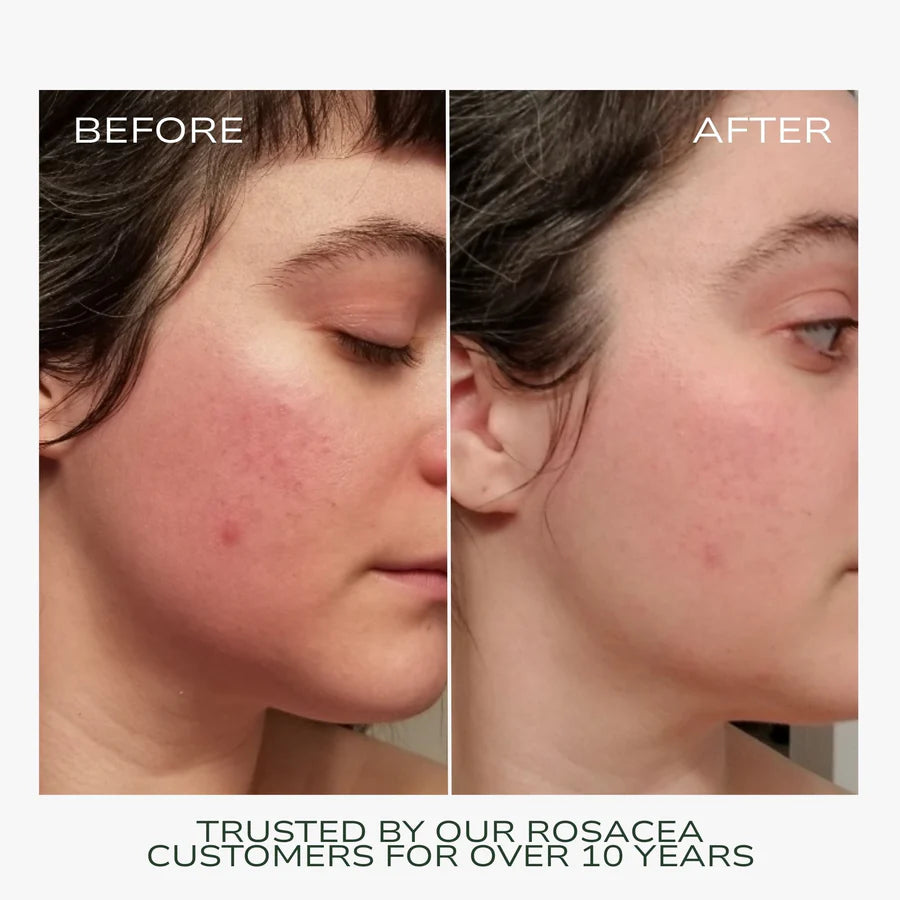 Redness Rescue Cream