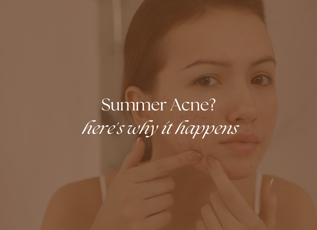 Sweat, Sunscreen & Breakouts: How to Prevent Summer Acne Naturally