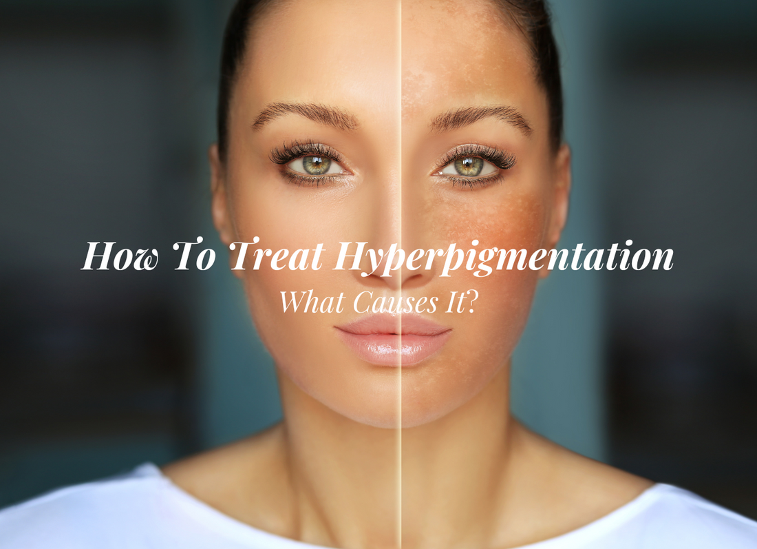 What You Need To Know About Hyper-Pigmentation