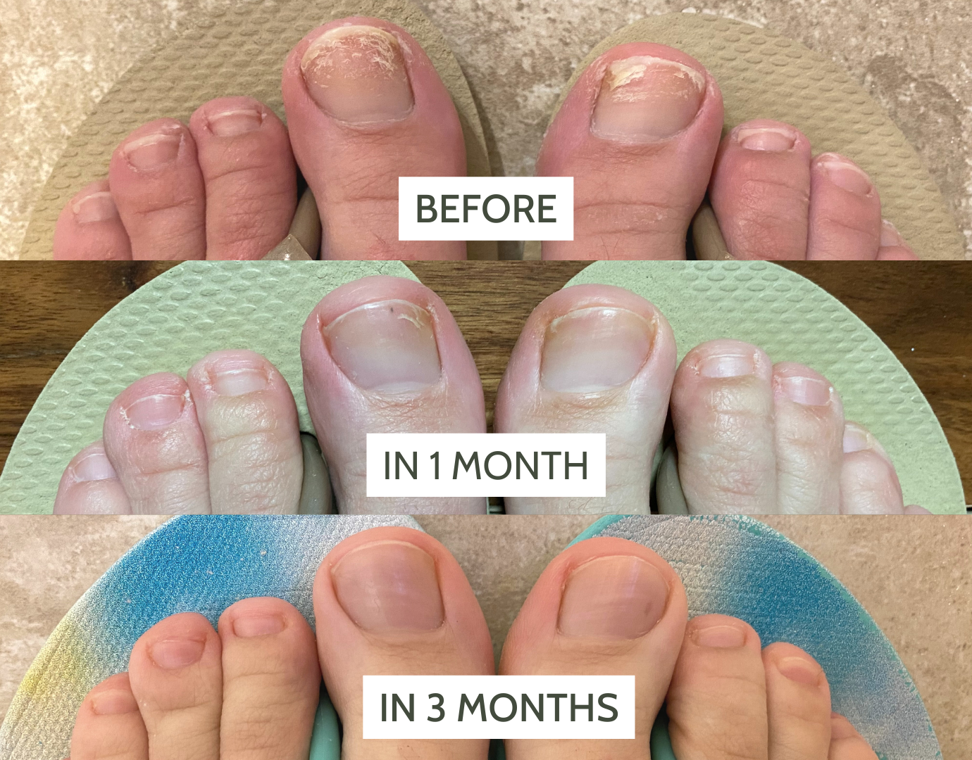 Castor Oil for Nail Fungus: The Miracle Cure?